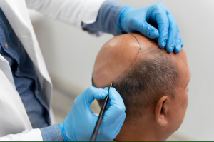 Hair Transplant vs. Other Hair Loss Solutions: How to Choose the Best Option