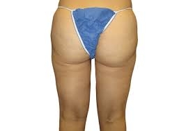 How To Take Care Of The Butt After Liposuction Surgery?