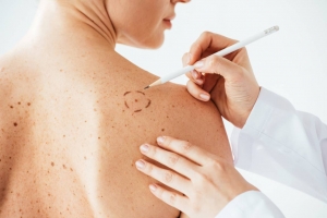 Mole Removal in Dubai: Exploring the Benefits of Modern Techniques