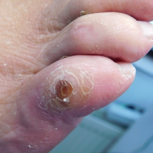 Diabetic Foot Ulcers Market Size, Epidemiology, Analysis & Trends 2024-2034