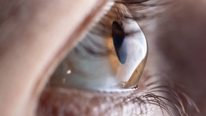 Understanding Keratoconus Symptoms, Causes, and Diagnosis