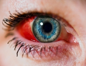 Blood in Eyes: Is It Alarming If Your Eye’s White Has Turned Scary Red?