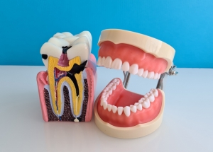 Root Canal Treatment Options for Inflammation in Dubai