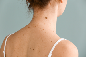 Understanding Birthmarks: Types and Causes