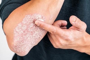 Is Psoriasis Dangerous? Understanding Risks and Effective Psoriasis Treatment in Riyadh
