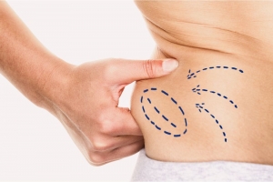 Benefits of Liposculpture You Should Know