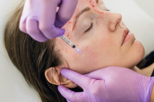 Understanding the Basics of Vampire Facelift Treatment: What You Need to Know