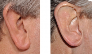 Minimally Invasive Ear Lobe Reduction: What You Should Know