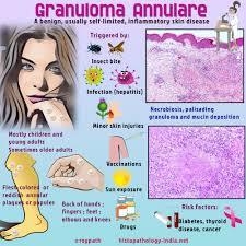 Granuloma Annulare: The Latest Breakthrough Treatments You Should Consider