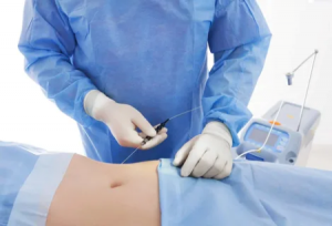 Exploring the Latest Liposuction Techniques Available in Abu Dhabi