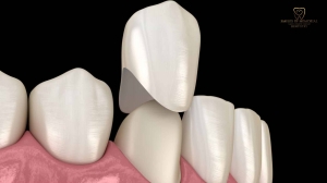 Your Complete Guide To Dental Crowns In London