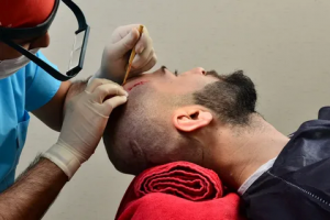 What to Expect from Hair Transplantation in Abu Dhabi