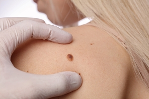 How Long Does Mole Removal Take? Expect the Process