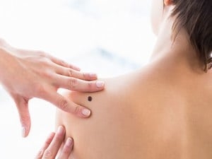 Are Moles Dangerous? Understanding the Risks