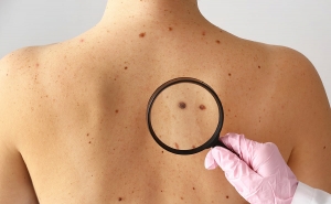 Choosing the Right Mole Removal Doctor: Key Factors