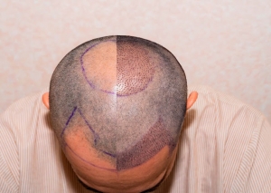 Hair Transplant Treatment in Chennai