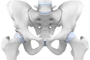 Hip Pain Treatment in Delhi| Pain Specialist in Delhi