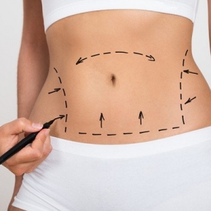 The Latest Advances in Liposuction Technology and Techniques