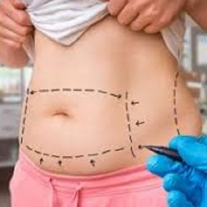 The Role of Technology in Modern Liposuction Procedures