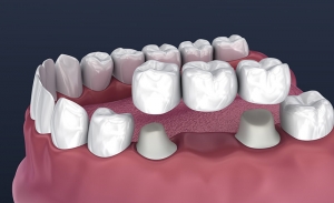 How Do Teeth Bridges Service Its Types & Ways To Improve The Life Of A Dental Bridge