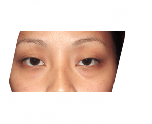 Knowing The Risks And Benefits Of Eye Lift Surgery