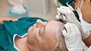 The Top 5 Reasons You Should Consider a Hair Transplant