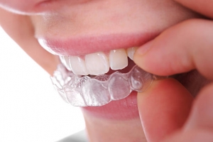 The Clear Alternative to Braces - Invisalign