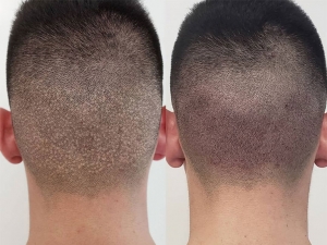 Is FUE Hair Transplant Right for You? Find Out Here