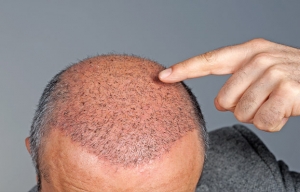 FUE Hair Transplants: Addressing Common Concerns