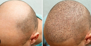 Painless Hair Restoration: FUE's Gentle Procedure