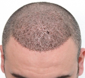 Hair Transplant Cost: What You Need to Know