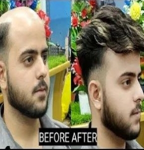 Top-Notch Hair Fixing Service in Santacruz West, Hair Wig Service in Santacruz West, and Hair Weaving Service in Mumbai by New Hair Trendz