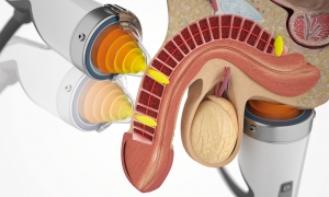 Shockwave Therapy vs. Traditional ED Treatments: What’s the Difference?