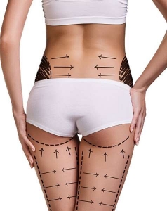 Affordable Liposuction in Riyadh: What’s the True Cost?