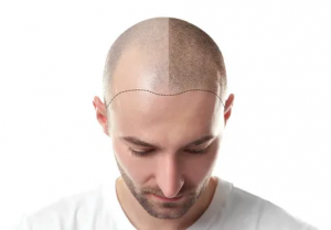 Hair Transplantation Techniques Explained: Abu Dhabi Insights