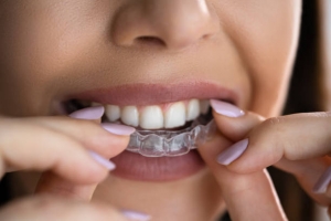 Invisalign – How Effective is It?