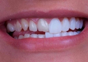 Process for Getting E-Max Veneers in Riyadh