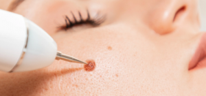 Say Goodbye to Skin Tags: Top Skin Tag Removal Treatments Revealed