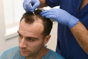 Hair Transplantation in Abu Dhabi for Men and Women