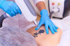 Revitalize Your Skin: Premier Laser Tattoo Removal in Riyadh