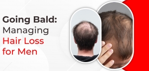 Going Bald: Managing Hair Loss for Men 