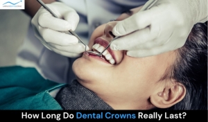 How Long Do Dental Crowns Really Last? Find Out Here!