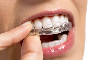 Straightforward Tips to Help You in the Upkeep of your Invisalign