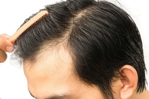 Hair Transplant: Your Investment in a Better You