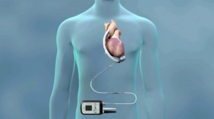 Ventricular Assist Device Market Size, Growth | Report 2024-2032