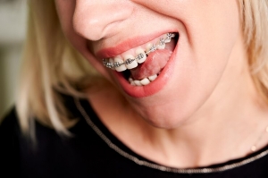 Exploring the Average Cost of Braces and Treatment Options in Dubai