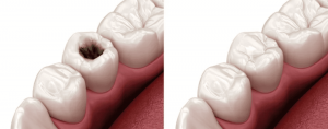 How Much Do Dental Fillings Cost in Riyadh? A Detailed Breakdown