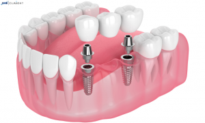 Comprehensive Analysis of the Global Dental Implant Market, Size, Growth, Trends, and Forecast (2024-2032)