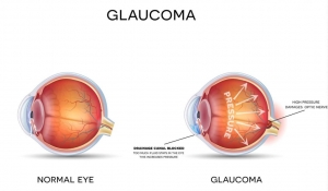 Regain Clear Vision with Cornea Transplant Surgery at Visionforlife.au