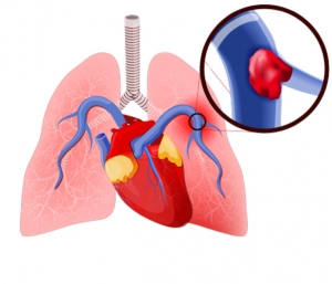 How to Find the Best Cardiologist in Hyderabad for Pulmonary Embolism?